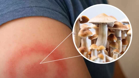 Psilocibina e Doença de Lyme Crônica: Uma Nova Fronteira da Ciência Psicodélica